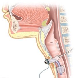 لوله ی تراکئوستومی