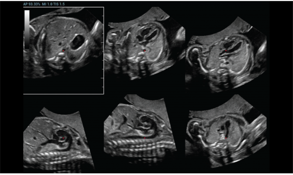 Smart Planes FH (Fetal Heart)